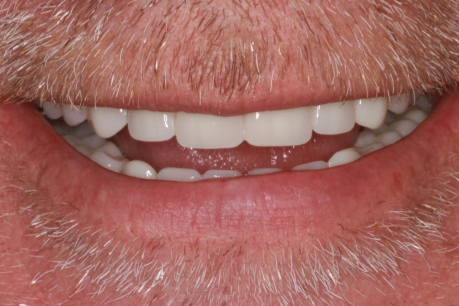 After Removable & Partial Dentures