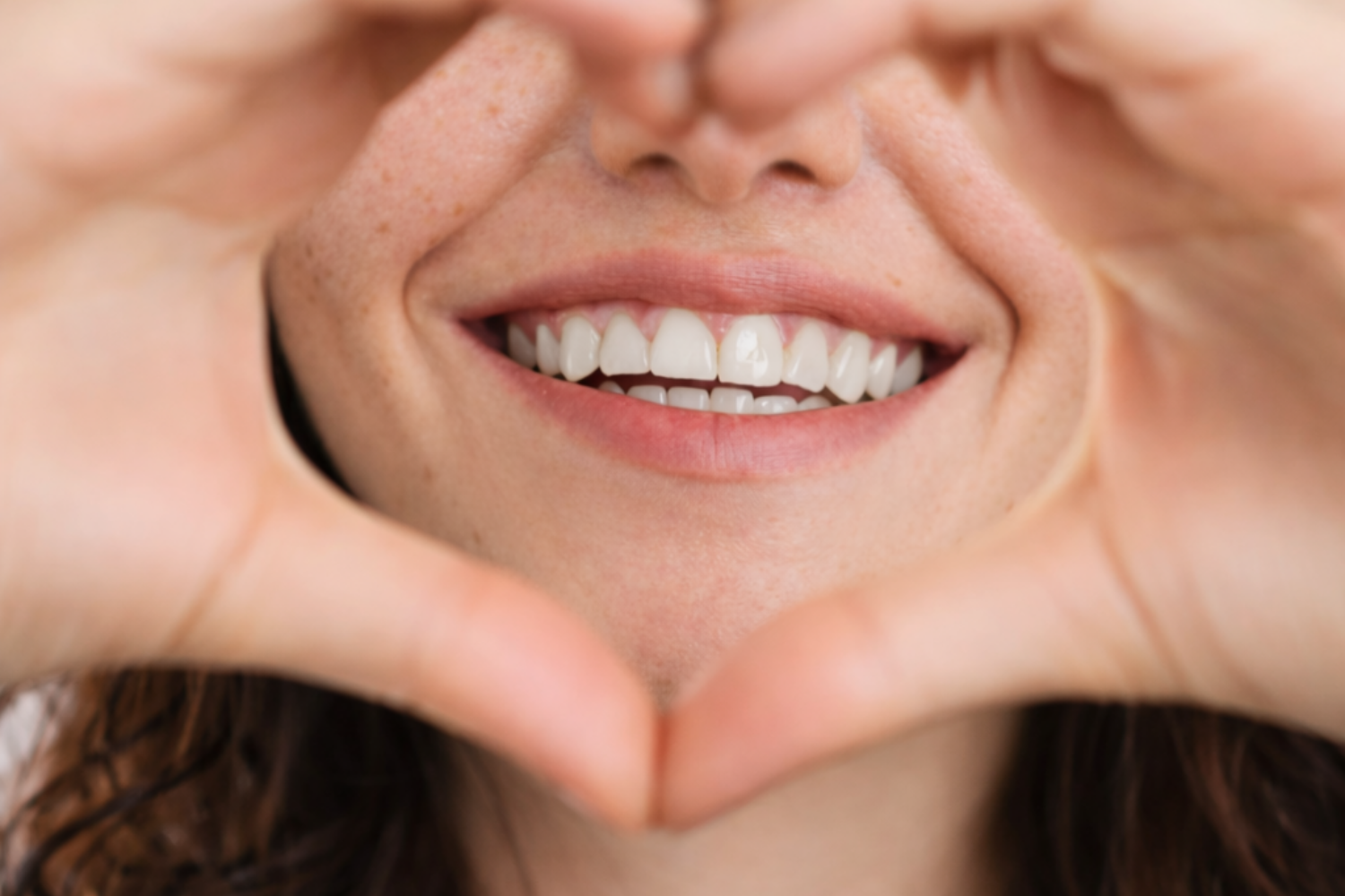 Veneers vs composite bonding