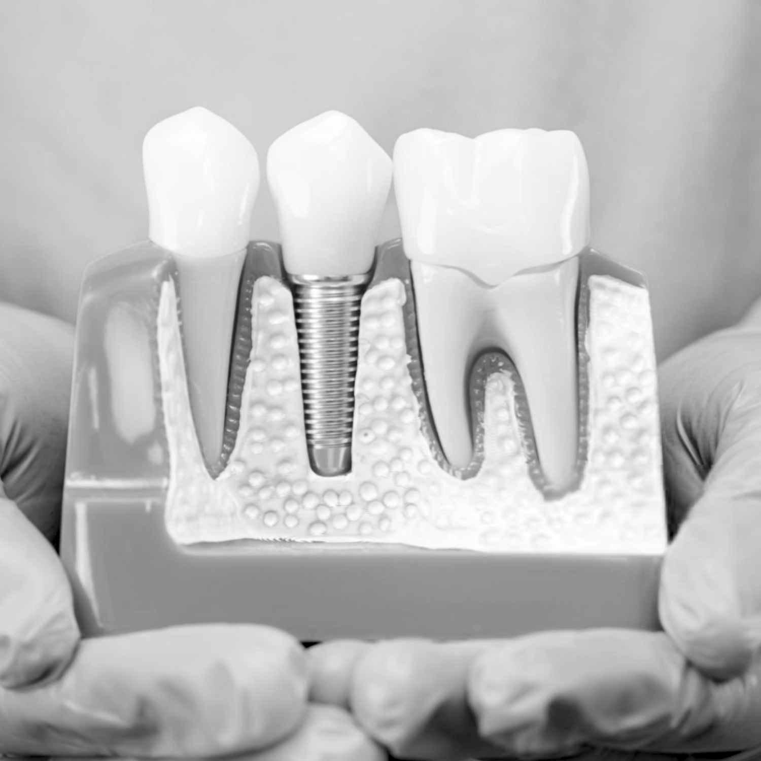 The Dental Implant Process