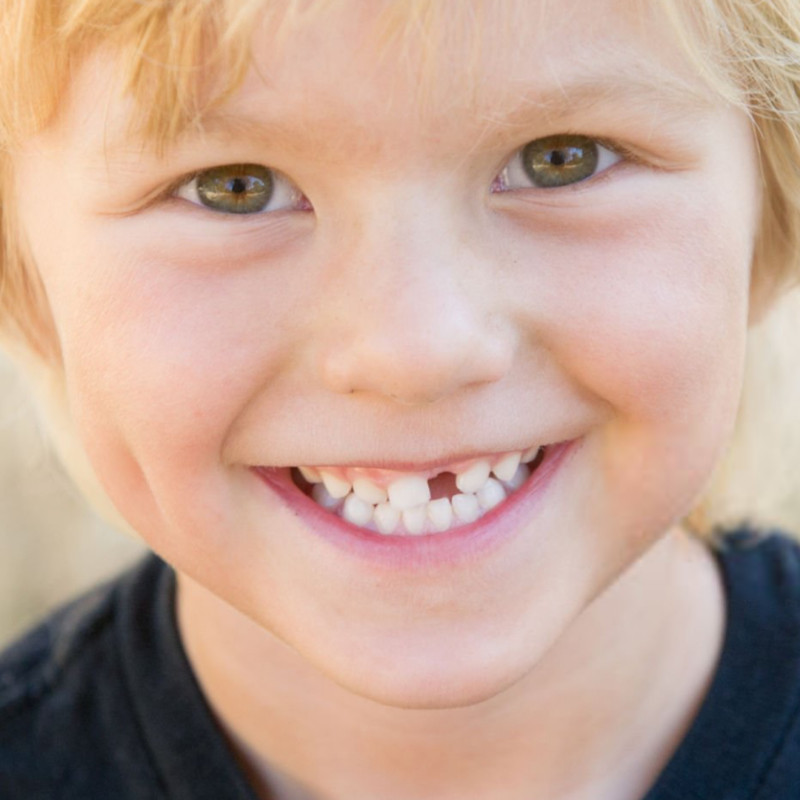 Children’s Dental Space Maintainers