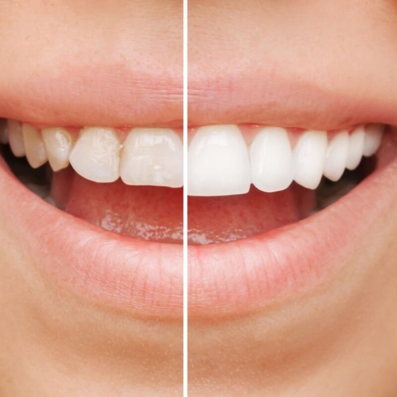 An introduction to dental ceramic veneers