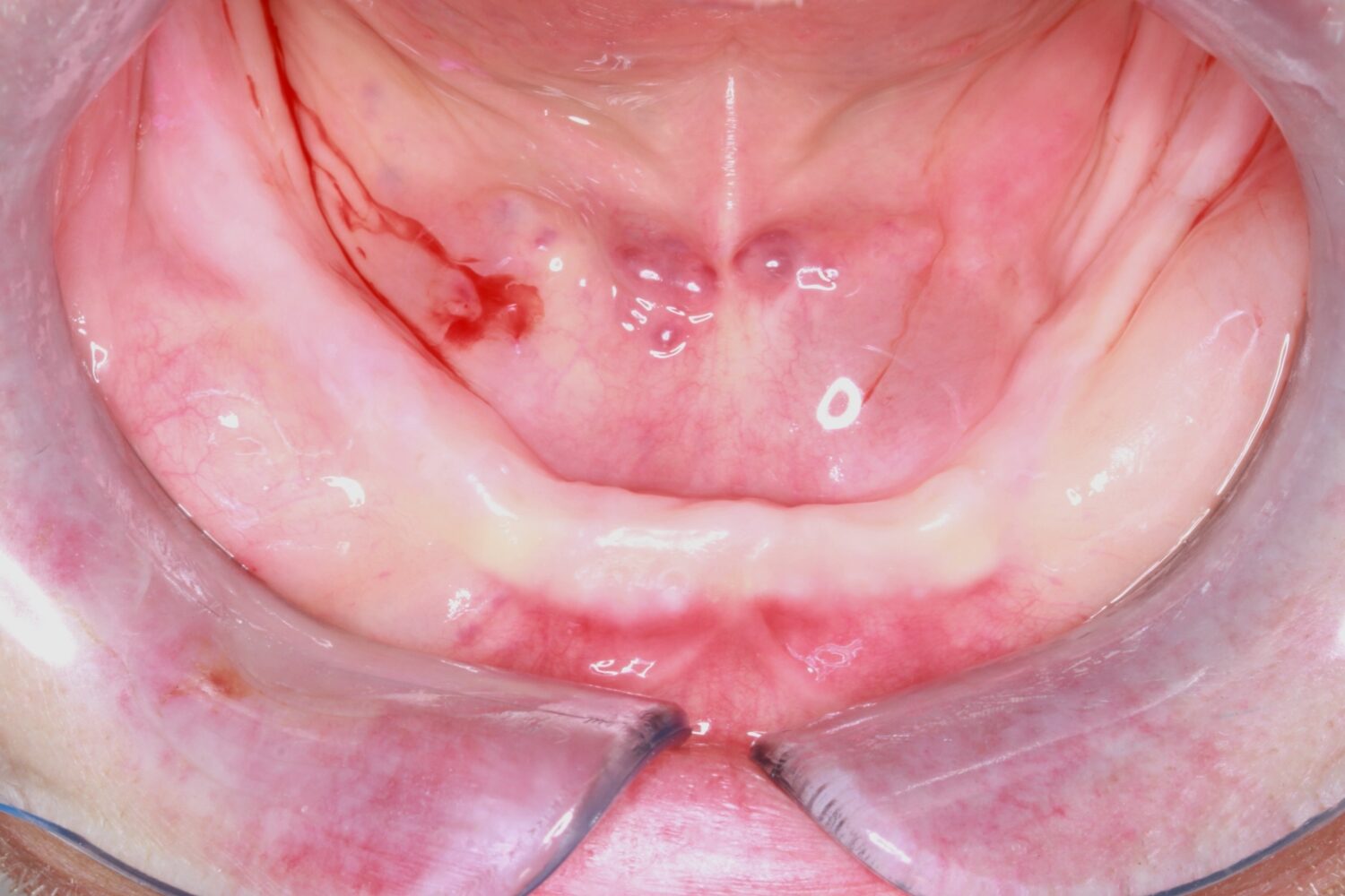 Before Removable & Partial Dentures