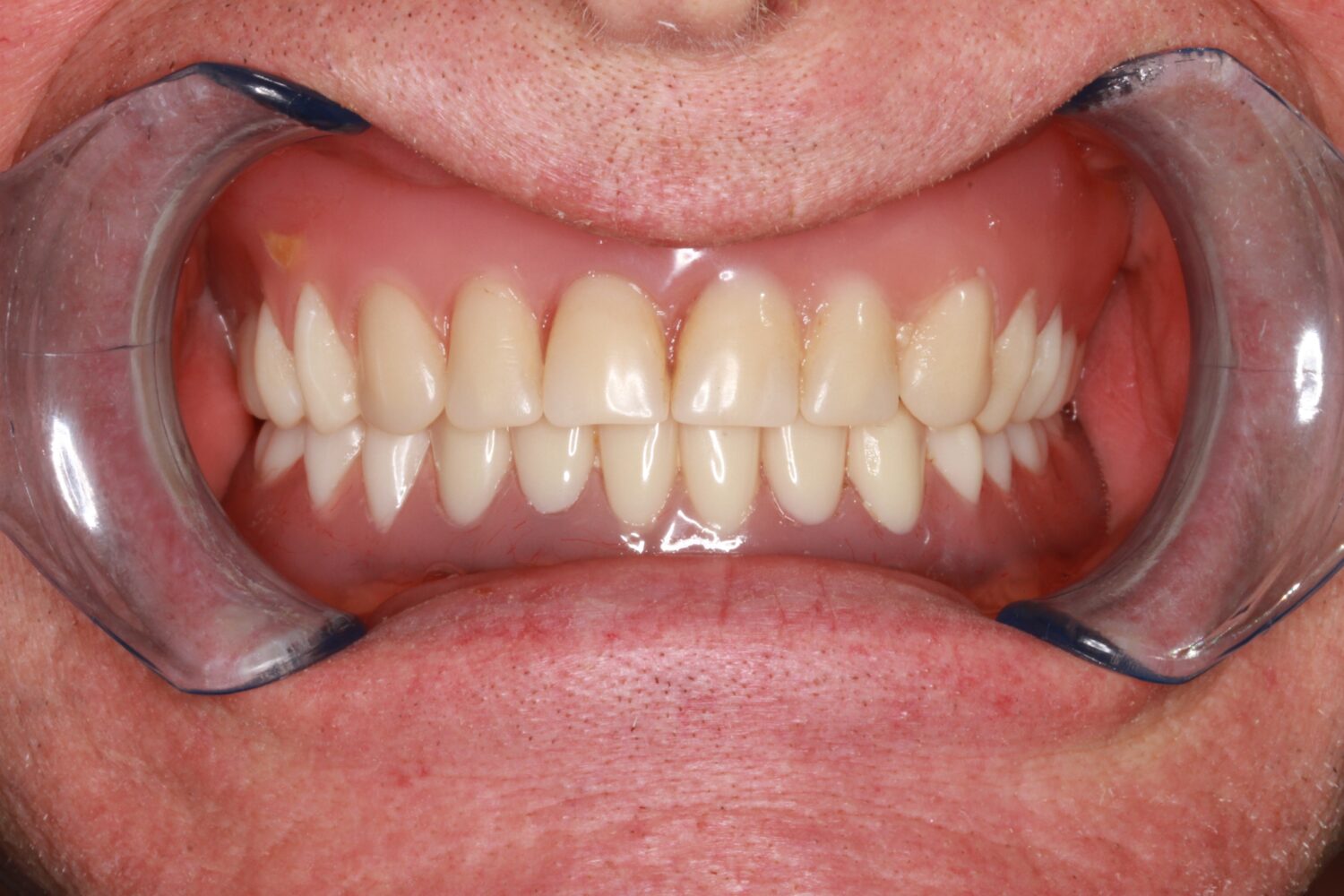 After Removable & Partial Dentures