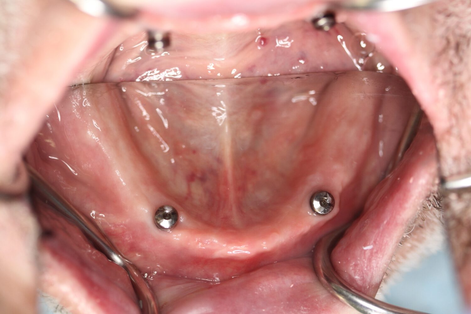 Before Removable & Partial Dentures