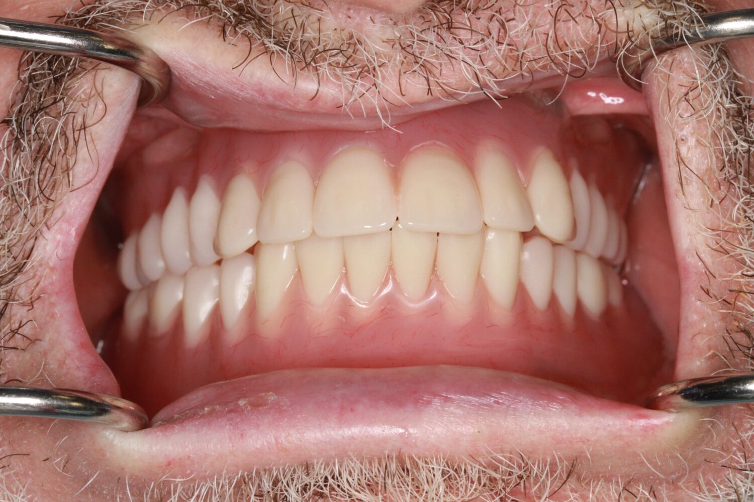 After Removable & Partial Dentures