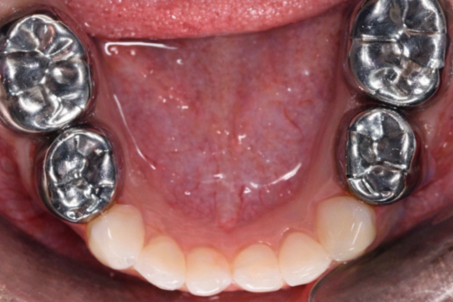 After Children's Dental Fillings