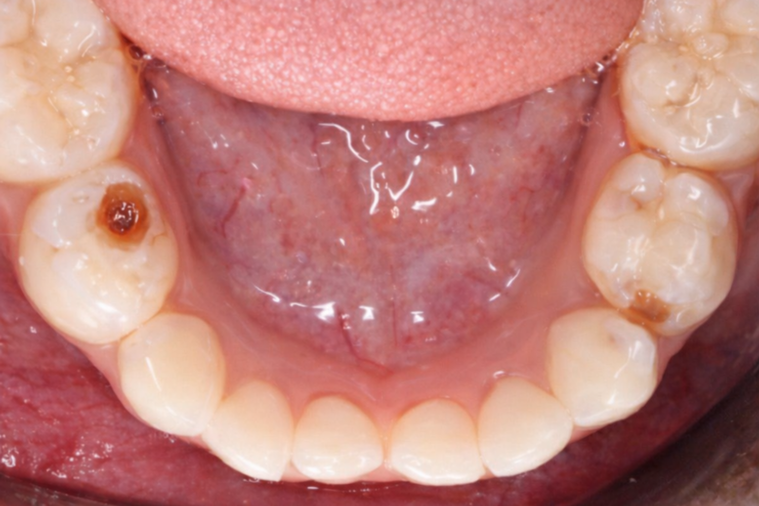 Before Children's Dental Fillings