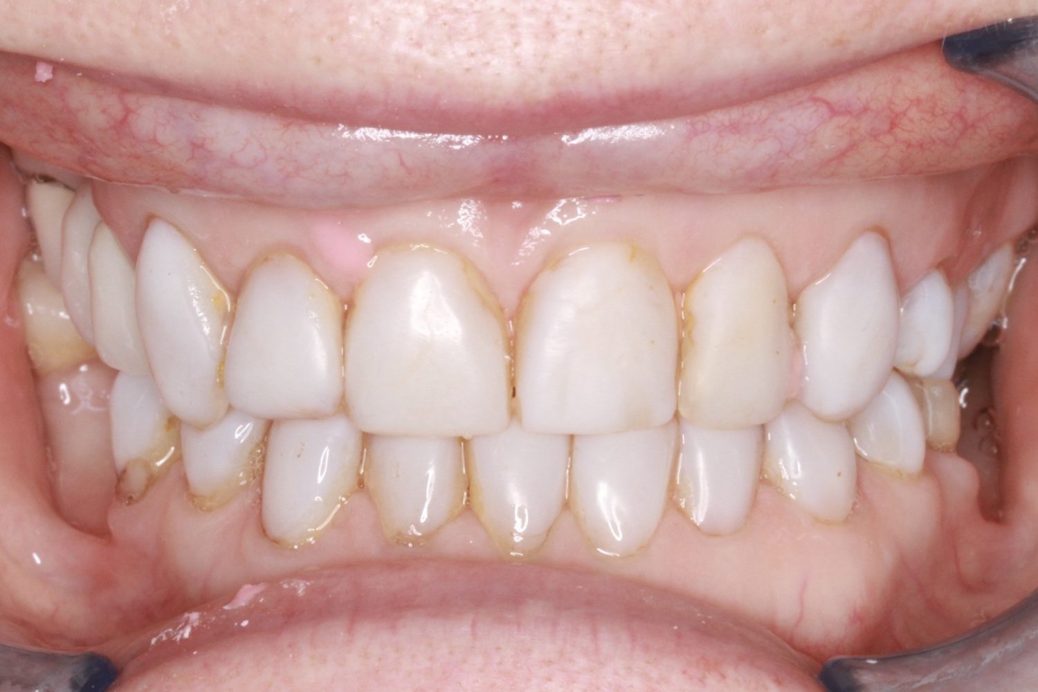 Before Teeth Veneers