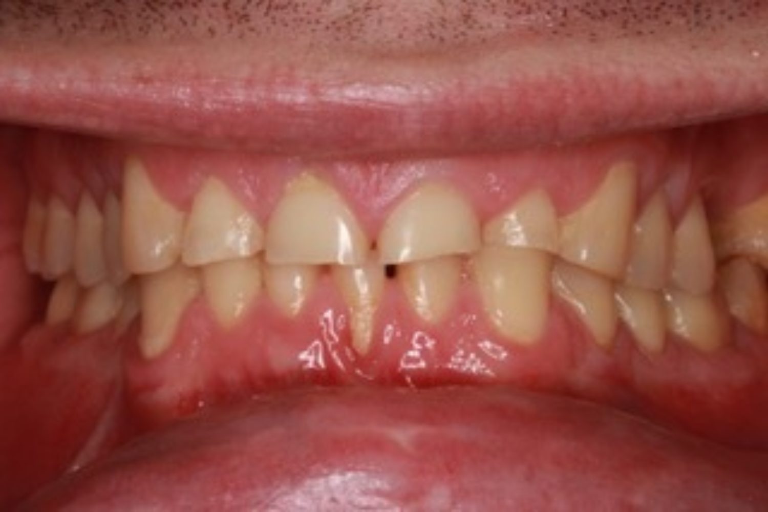 What is Considered Basic Restorative Dental Work?