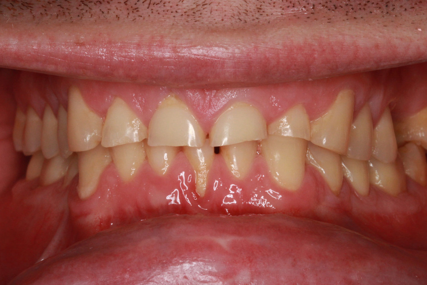 Before Major Restorative Dental Treatment