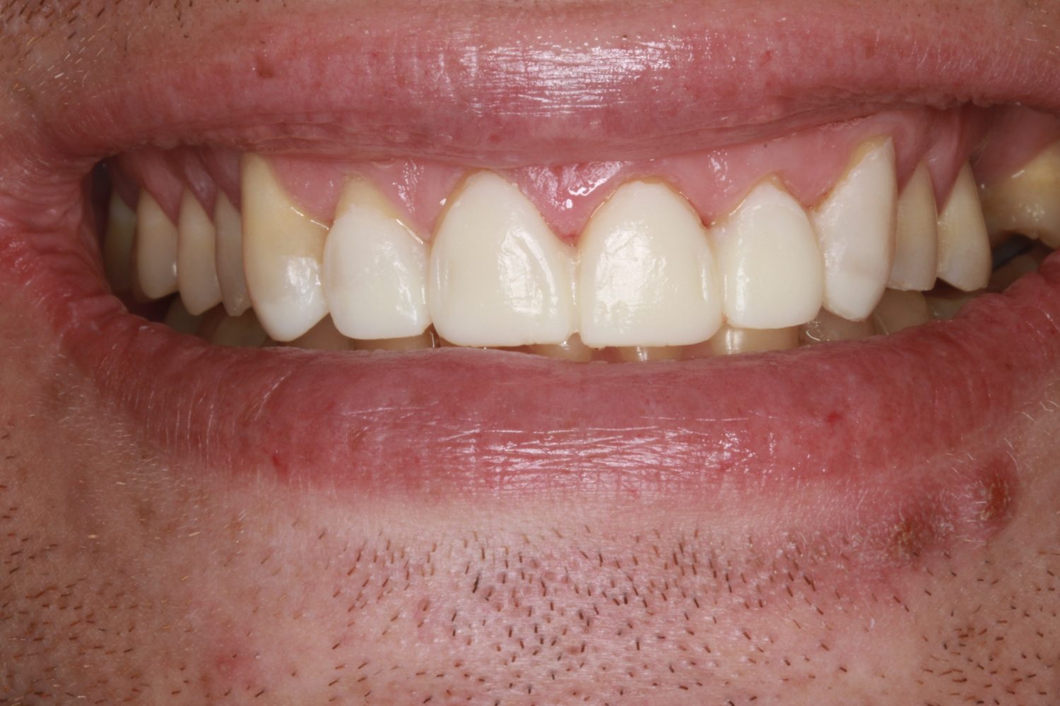 After Major Restorative Dental Treatment