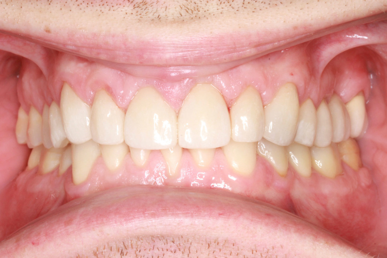 After Major Restorative Dental Treatment