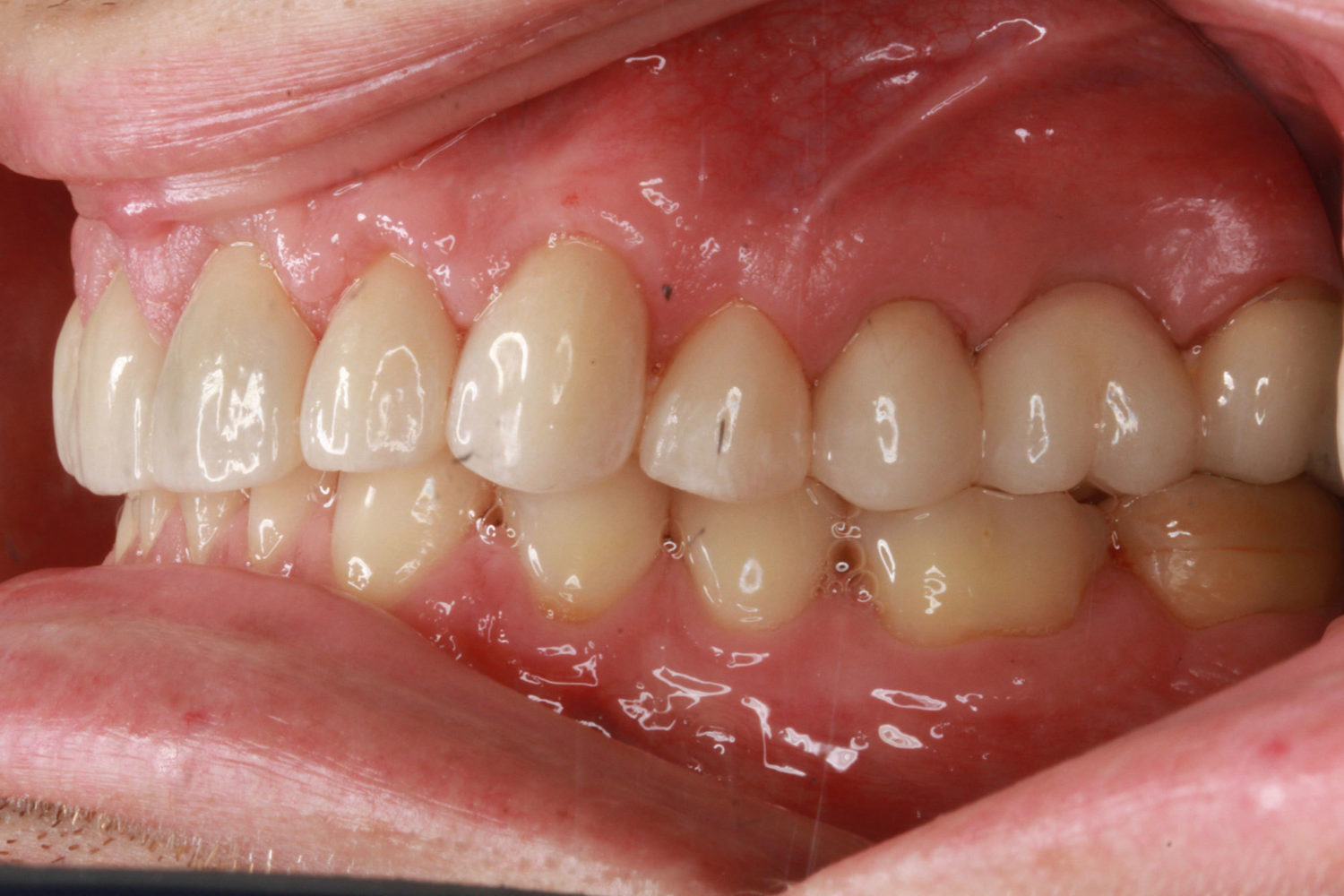 After Major Restorative Dental Treatment