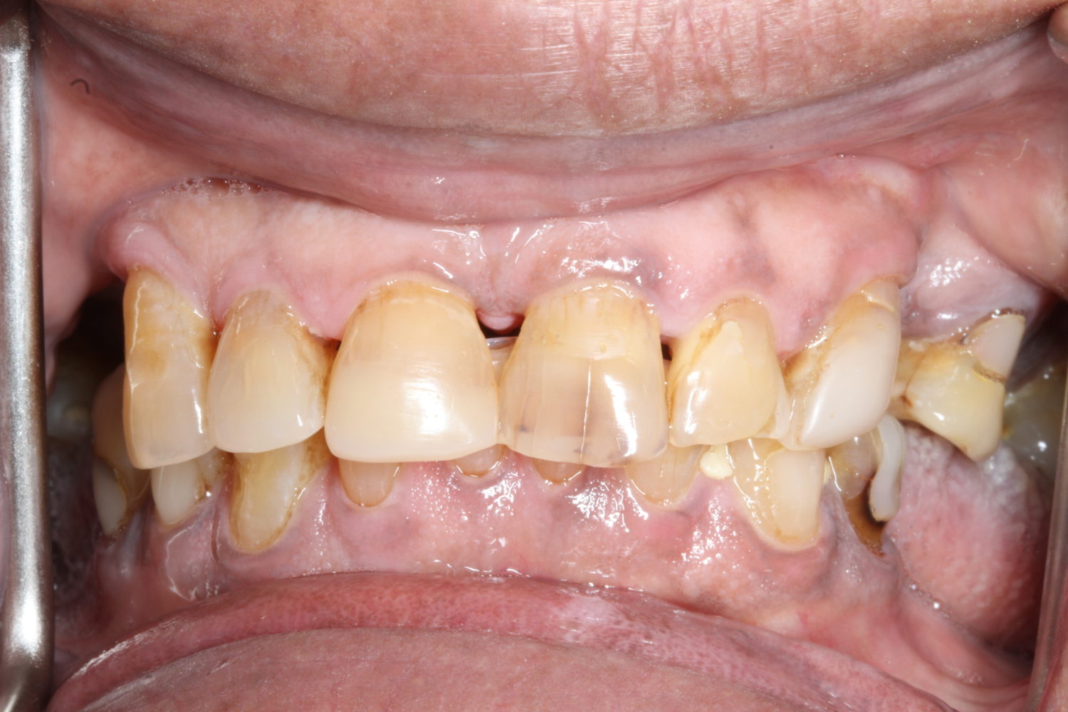 Before Major Restorative Dental Treatment