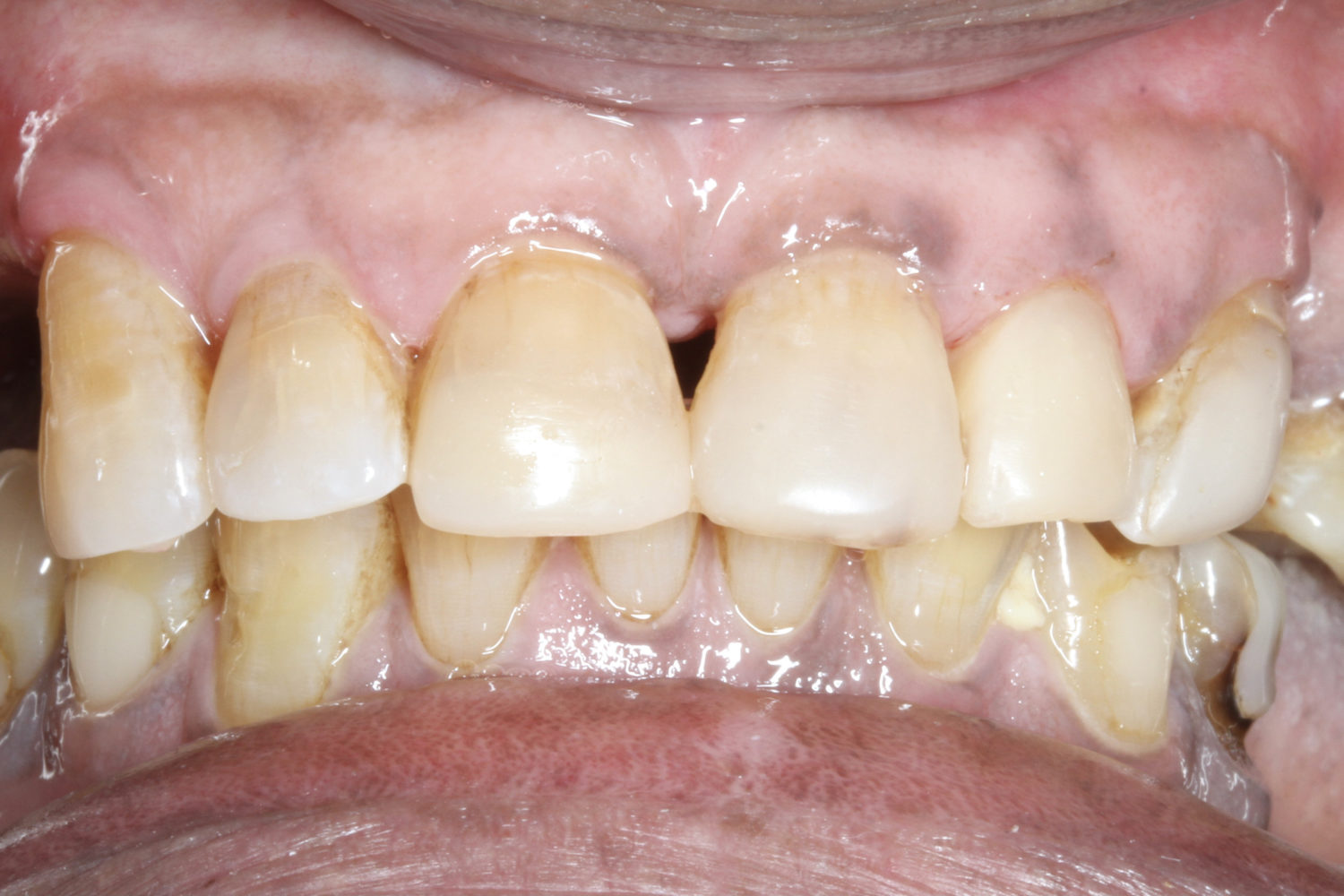 After Major Restorative Dental Treatment