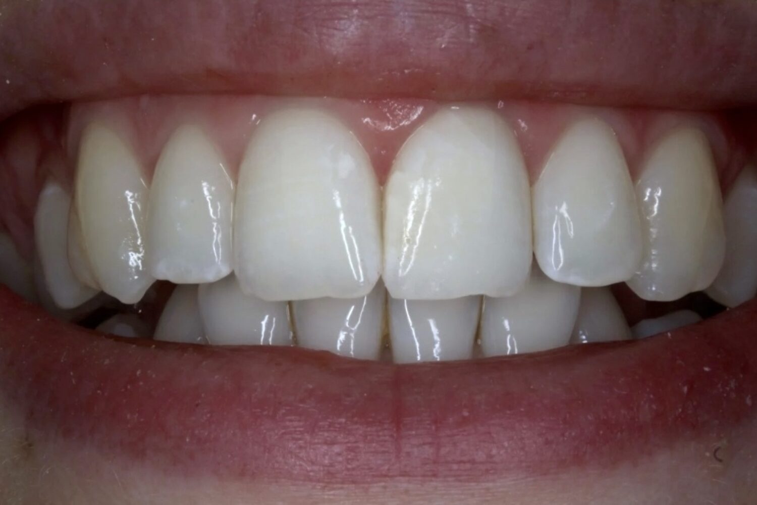 After Teeth Whitening
