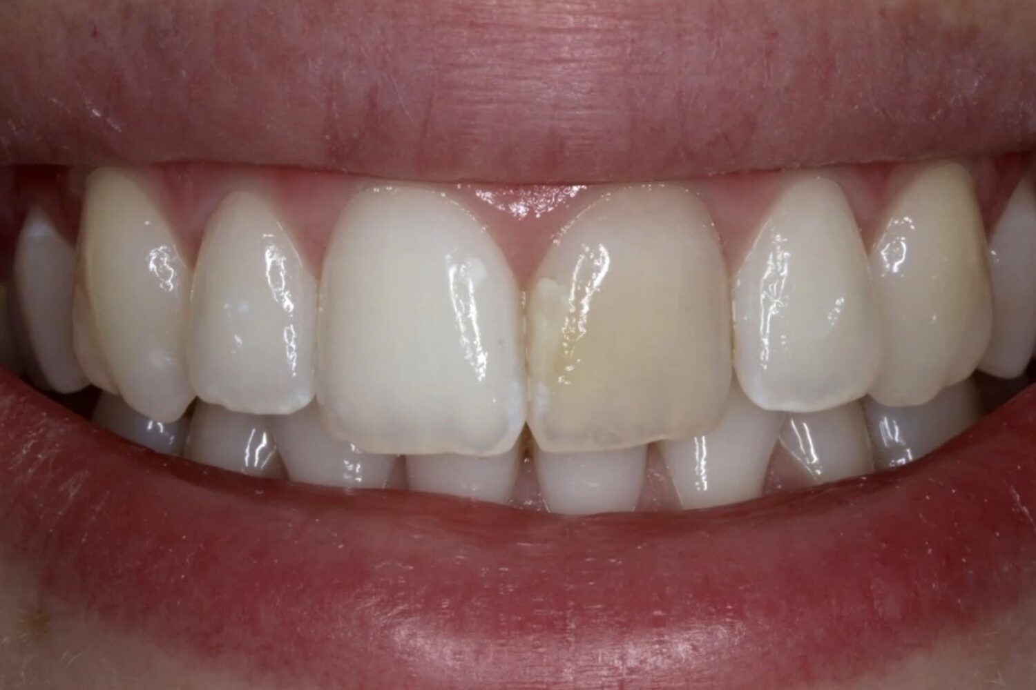 Before Teeth Whitening