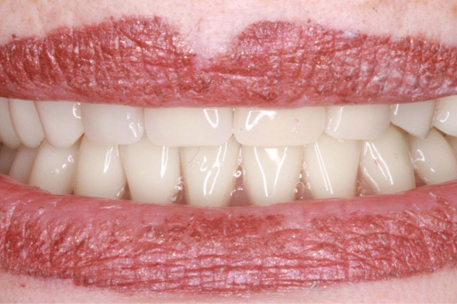 Before Removable & Partial Dentures