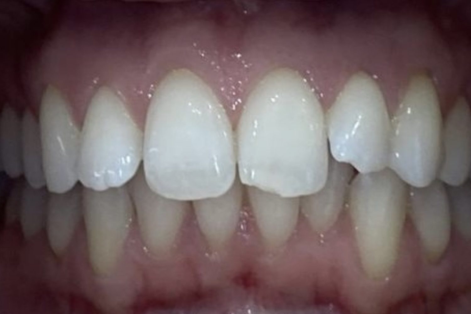 Before Teeth Straightening