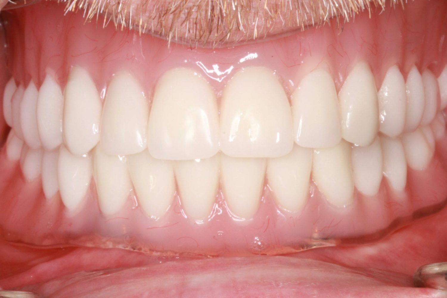 After Removable & Partial Dentures