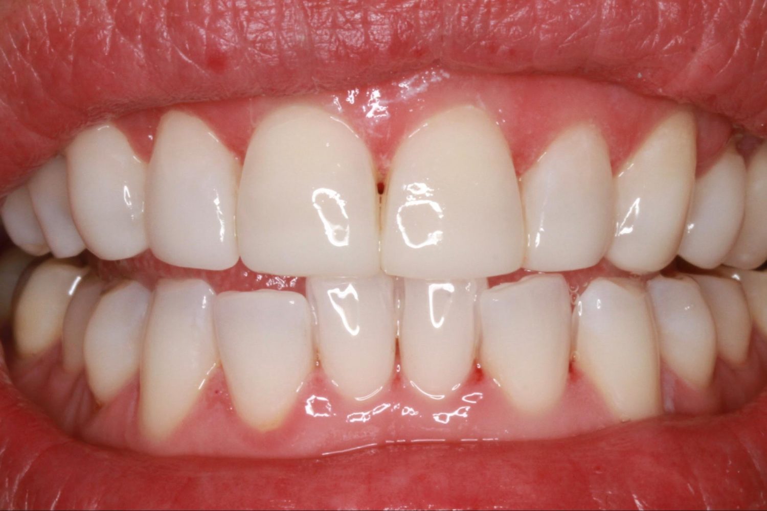 After Teeth Veneers