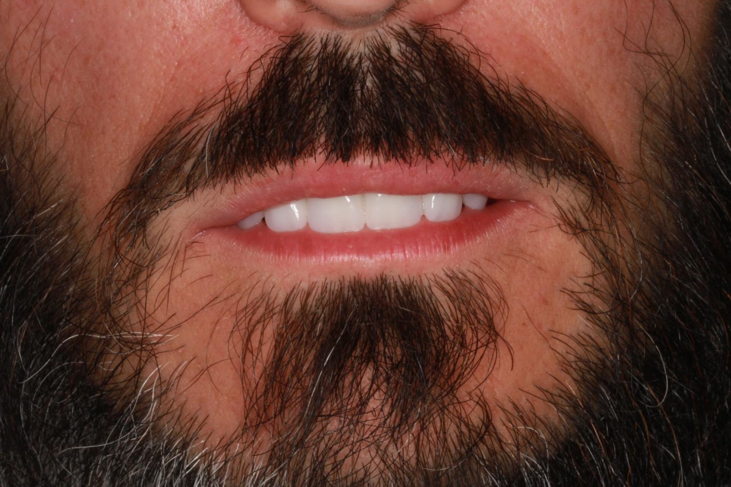 After Dental Implants