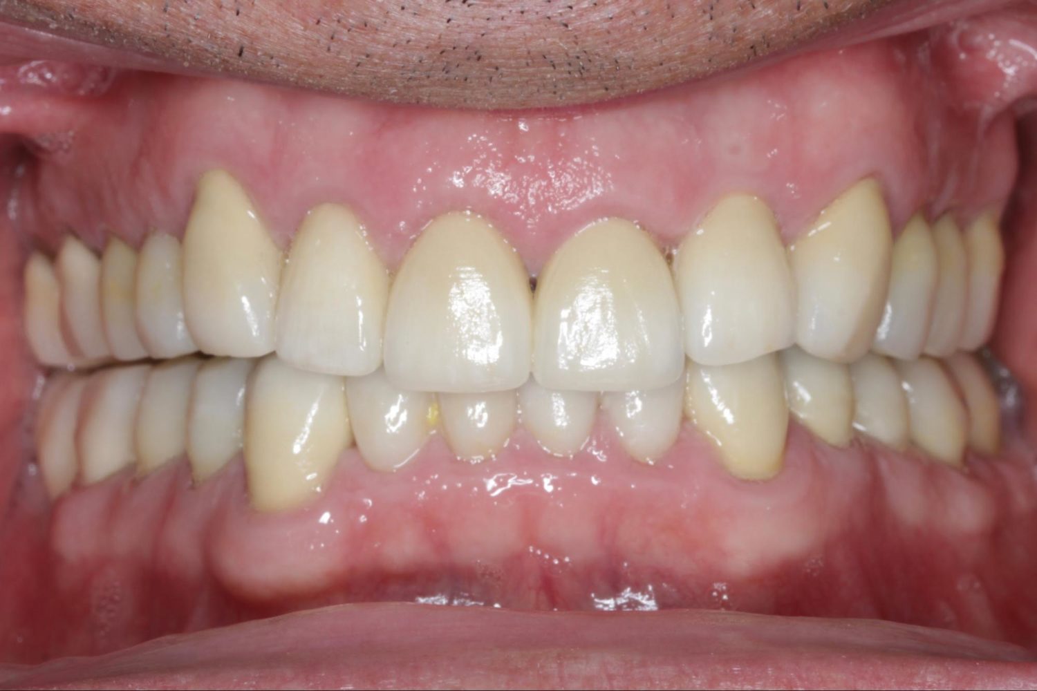 After Major Restorative Dental Treatment