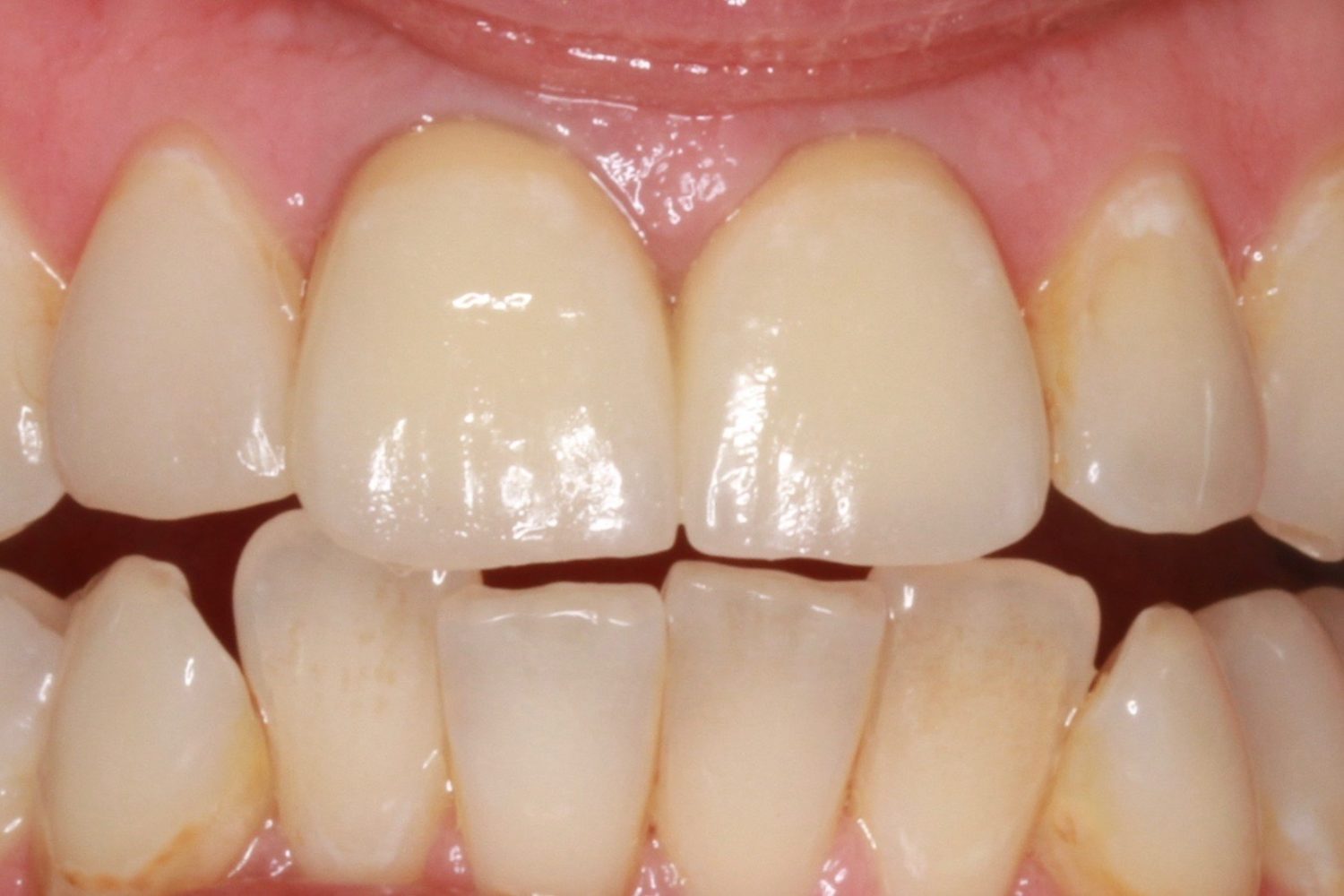 After Dental Crowns