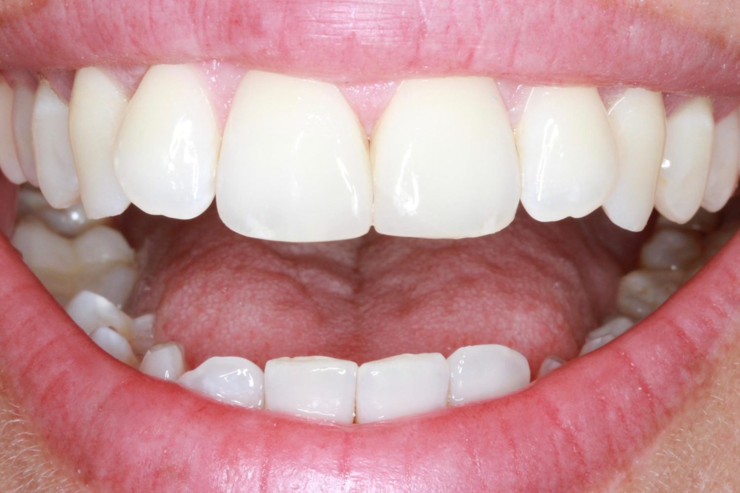 After Teeth Veneers