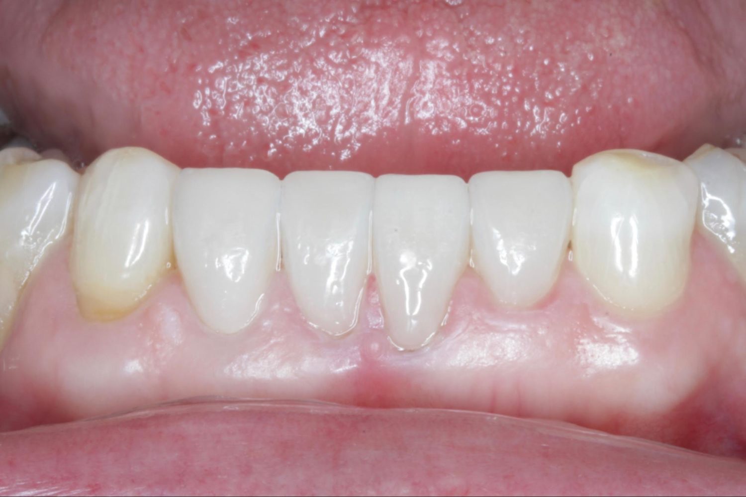 After Teeth Veneers