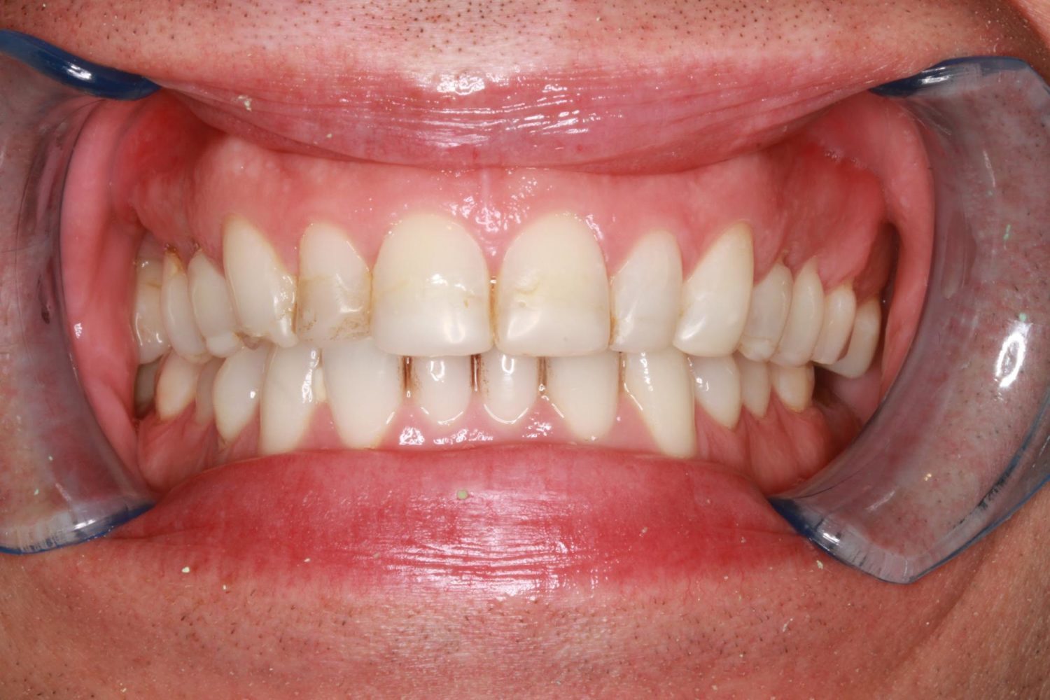 Before Teeth Veneers