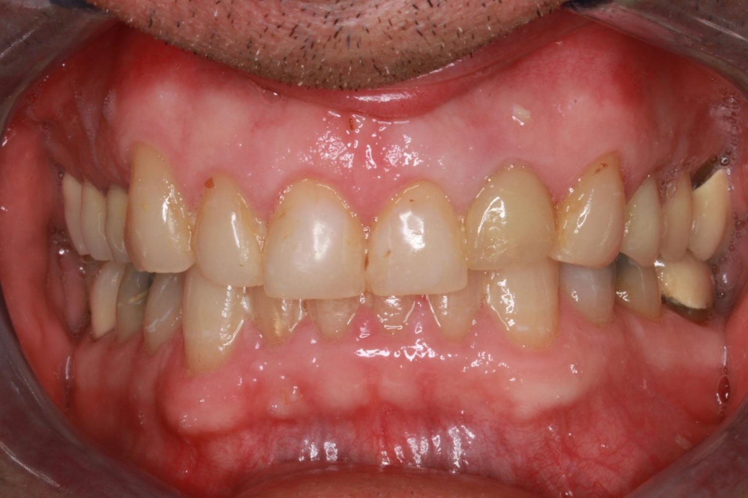 Before Major Restorative Dental Treatment