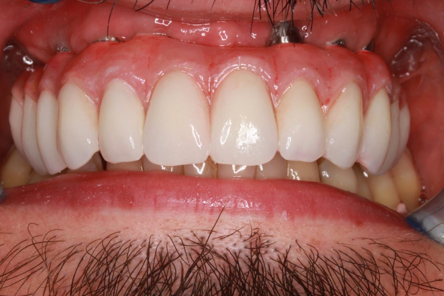 After Dental Implants