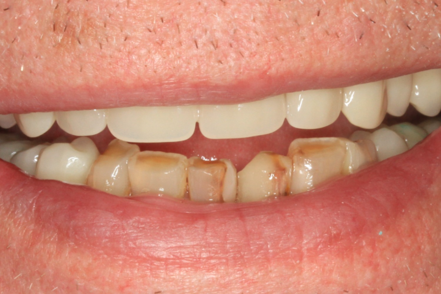 Before Removable & Partial Dentures