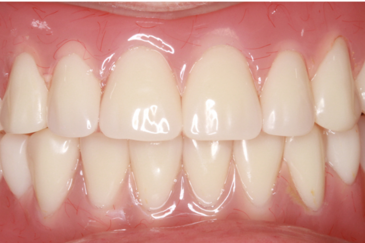After Removable & Partial Dentures