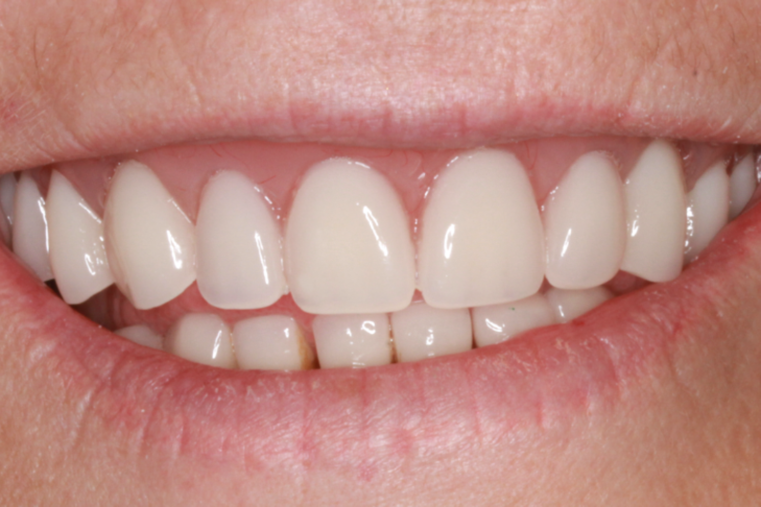 After Removable & Partial Dentures