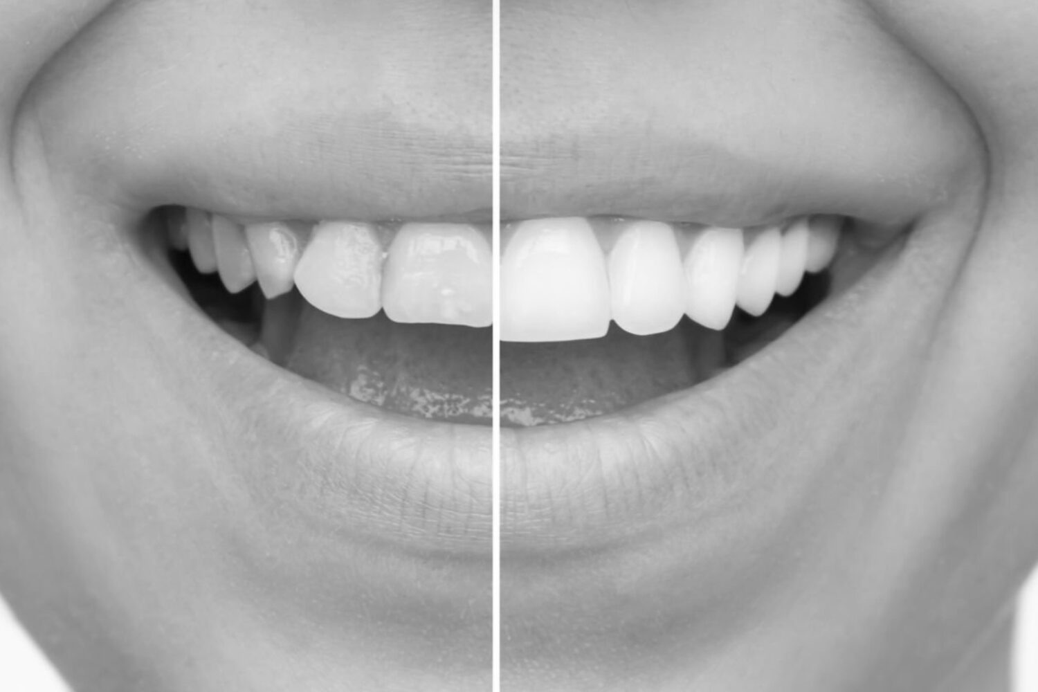 More abouce ceramic veneers