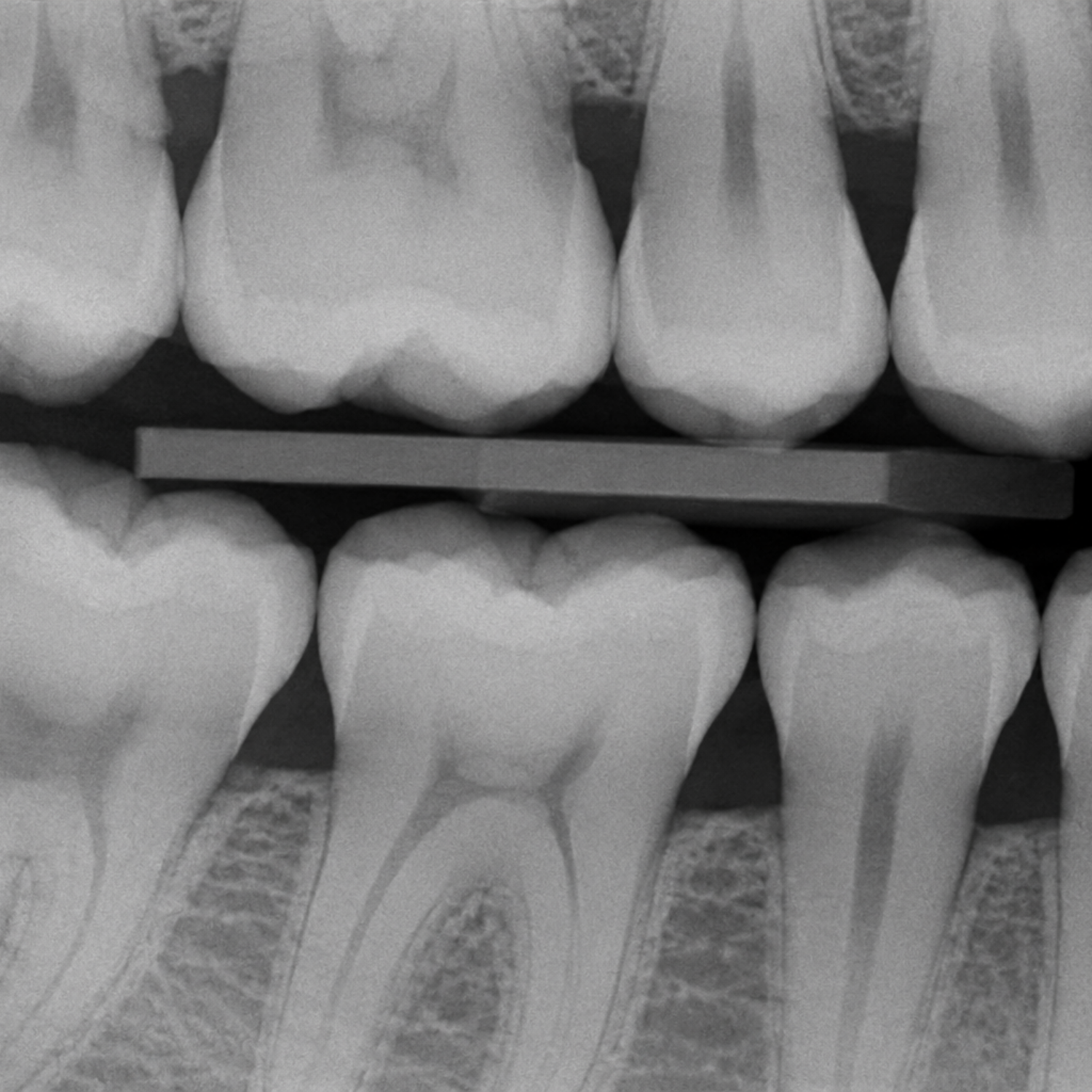 Bitewing X-Rays
