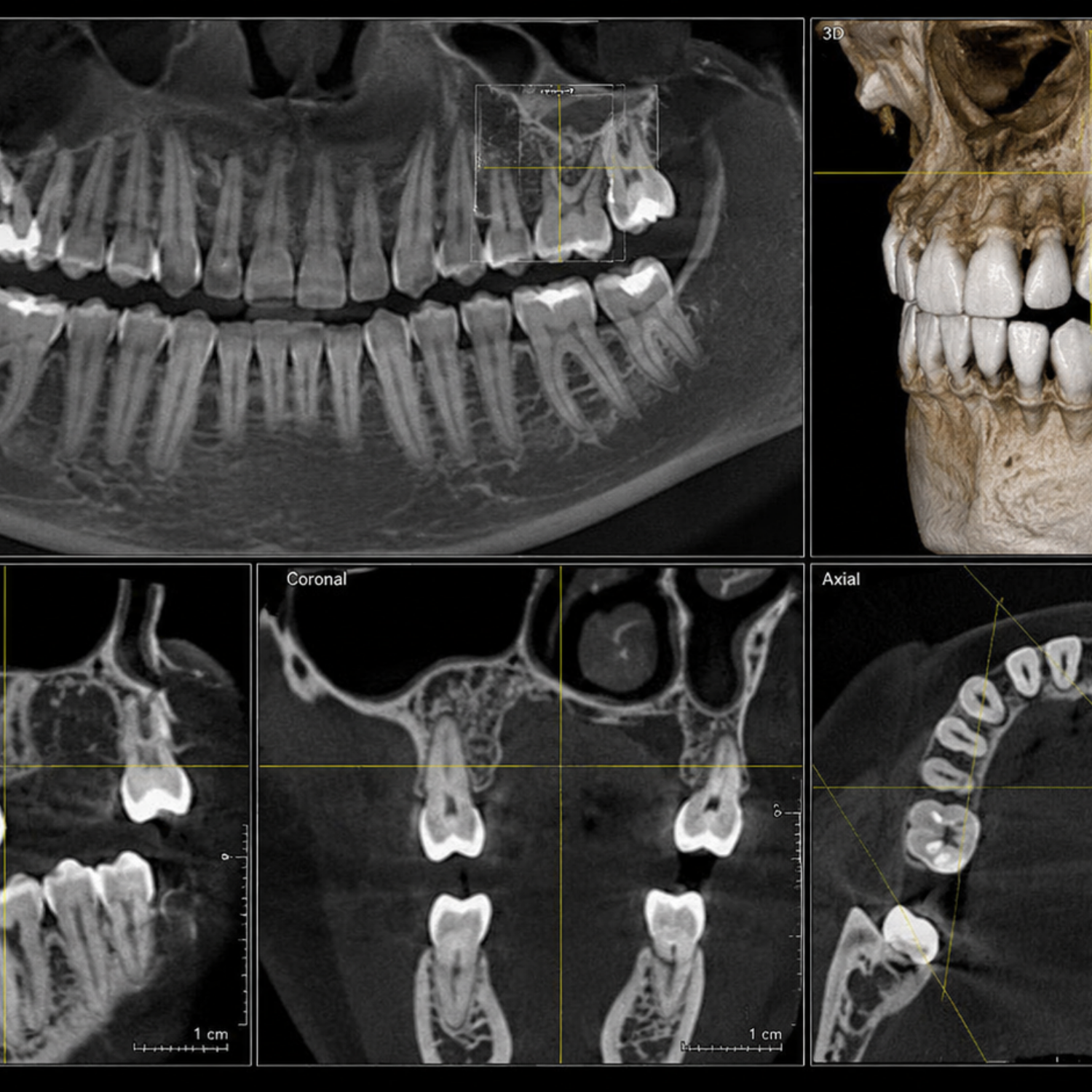 CBCT Scans