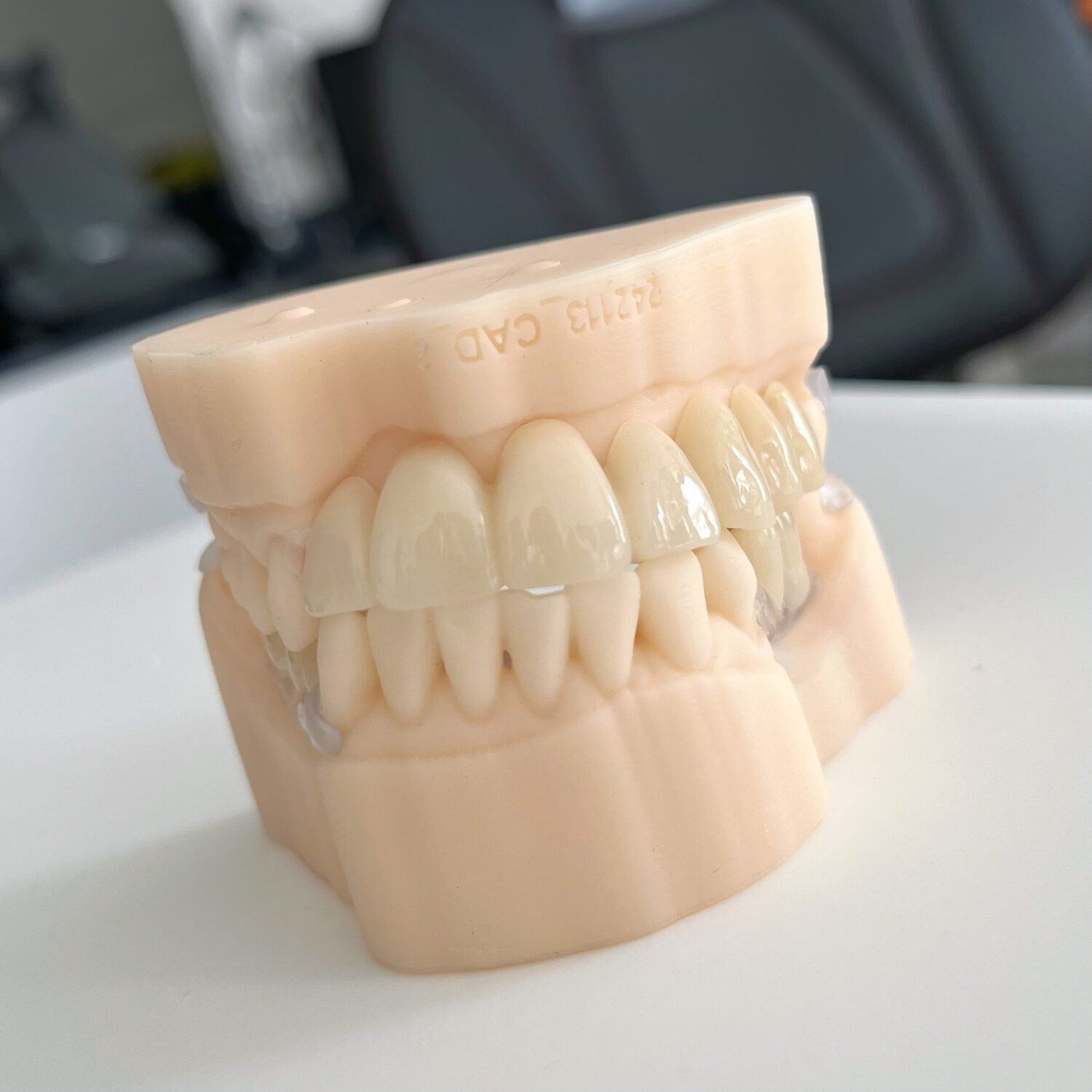 Crown Fitting Appointment