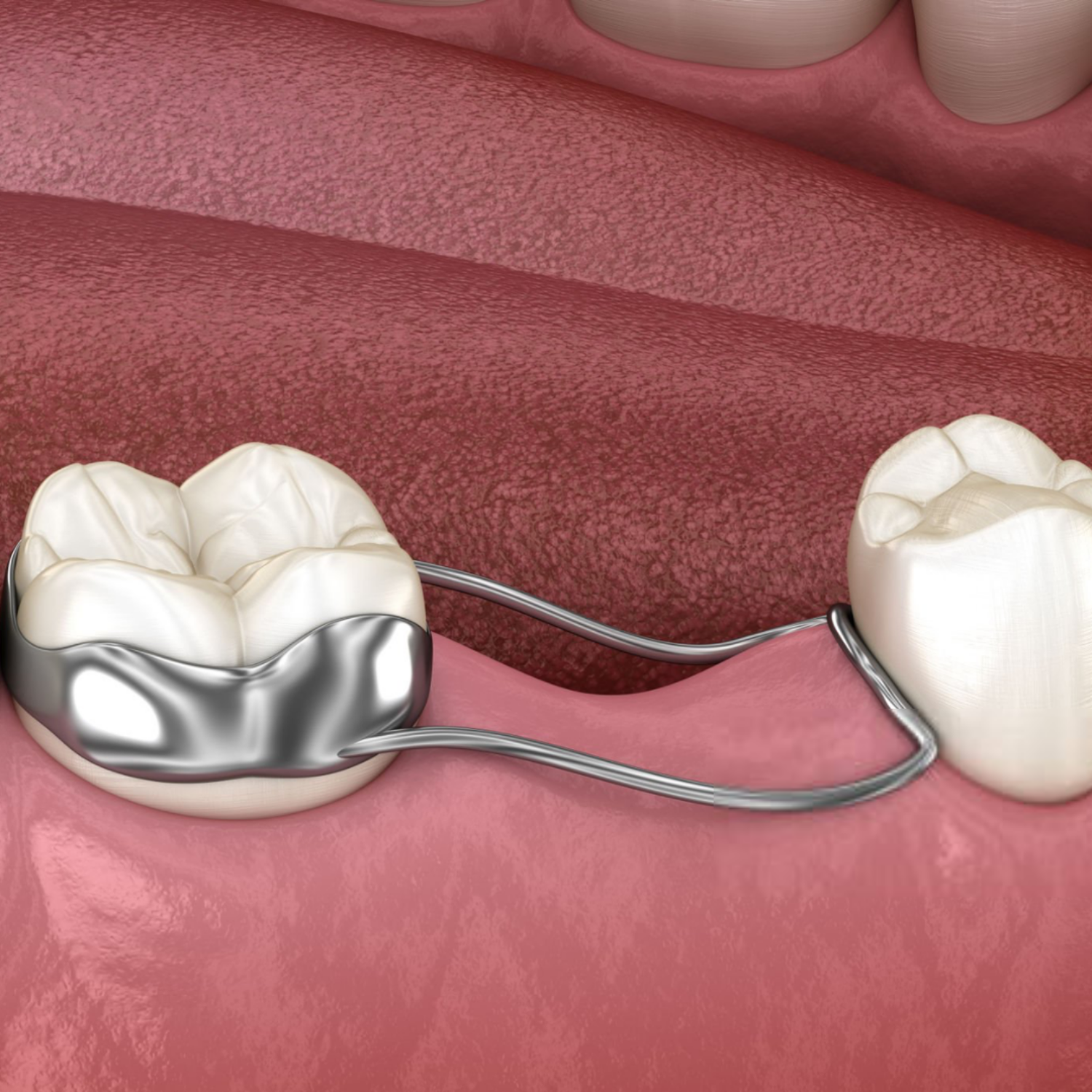 How to Care for a Child’s Space Maintainer