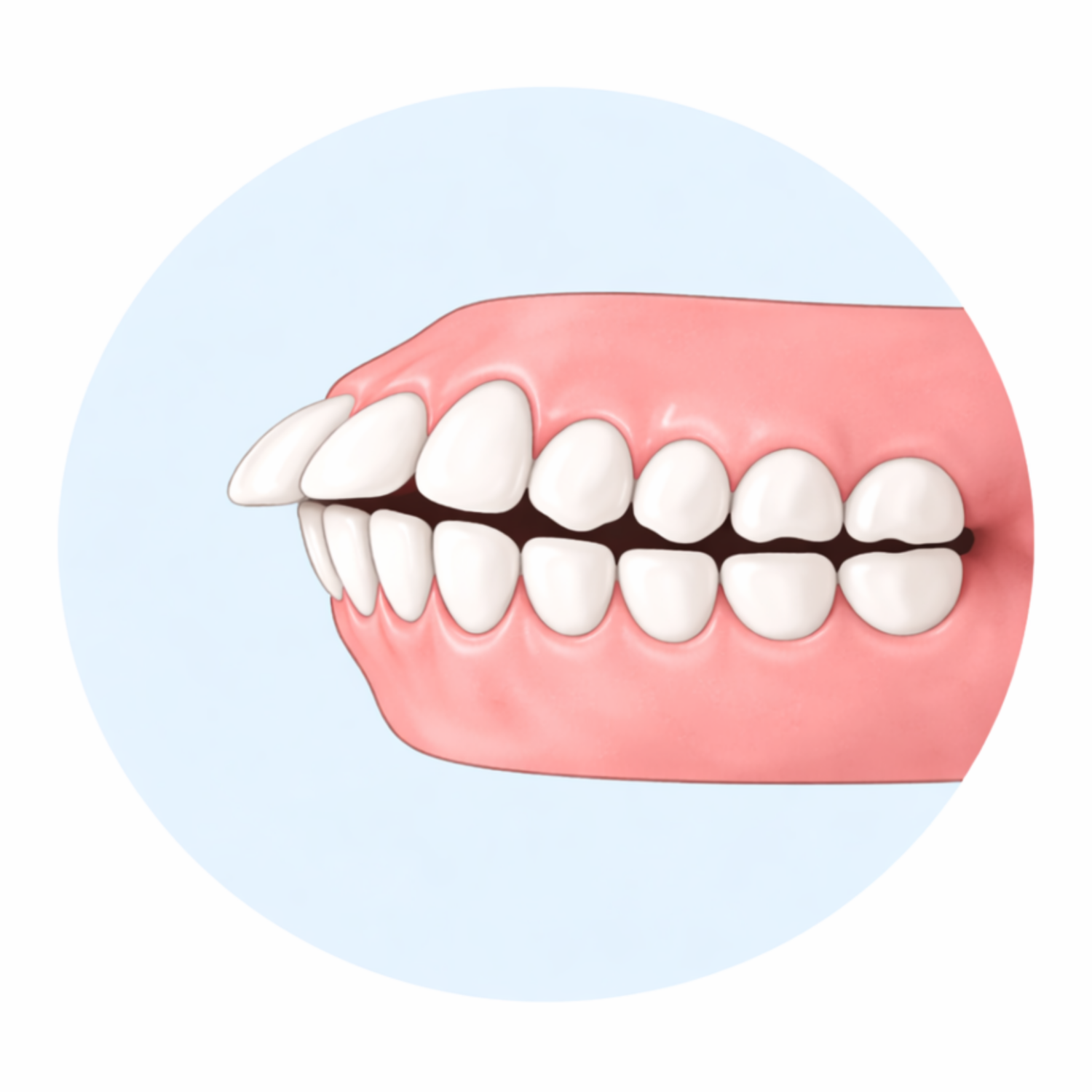 Protruding front teeth (overjet)