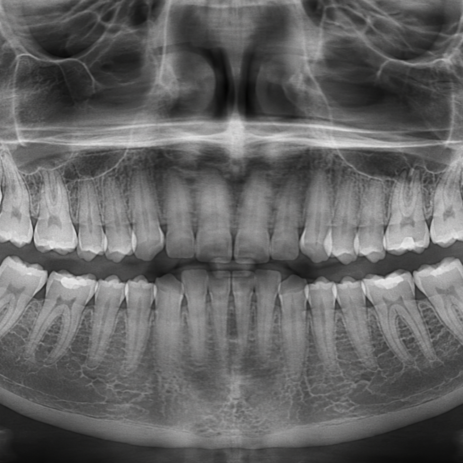 Panoramic X-Rays