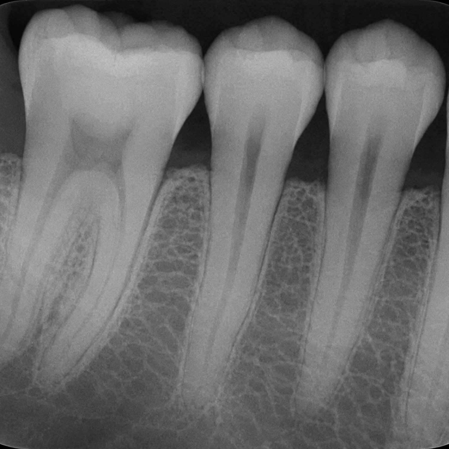 Periapical X-Rays
