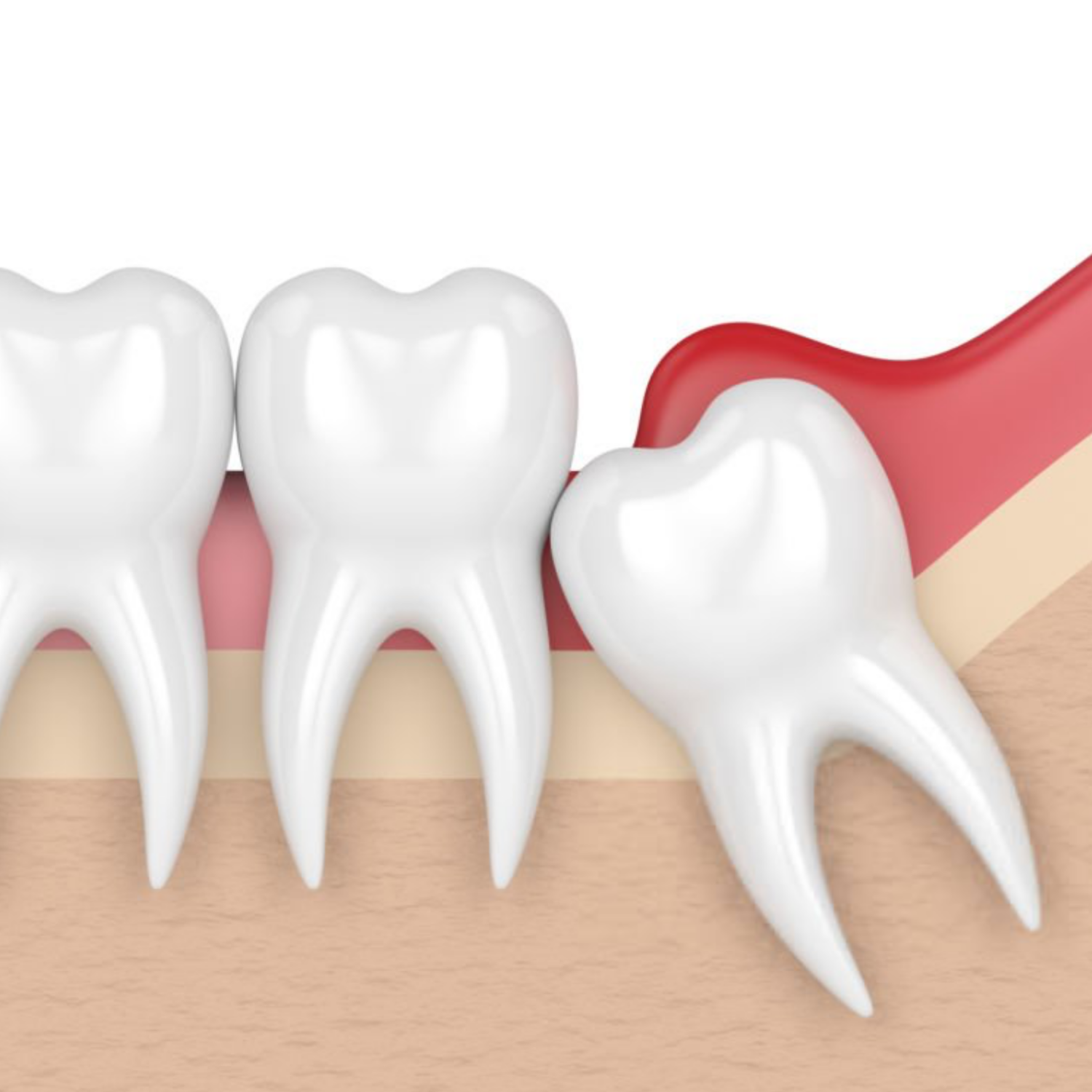 What Is Pericoronitis?