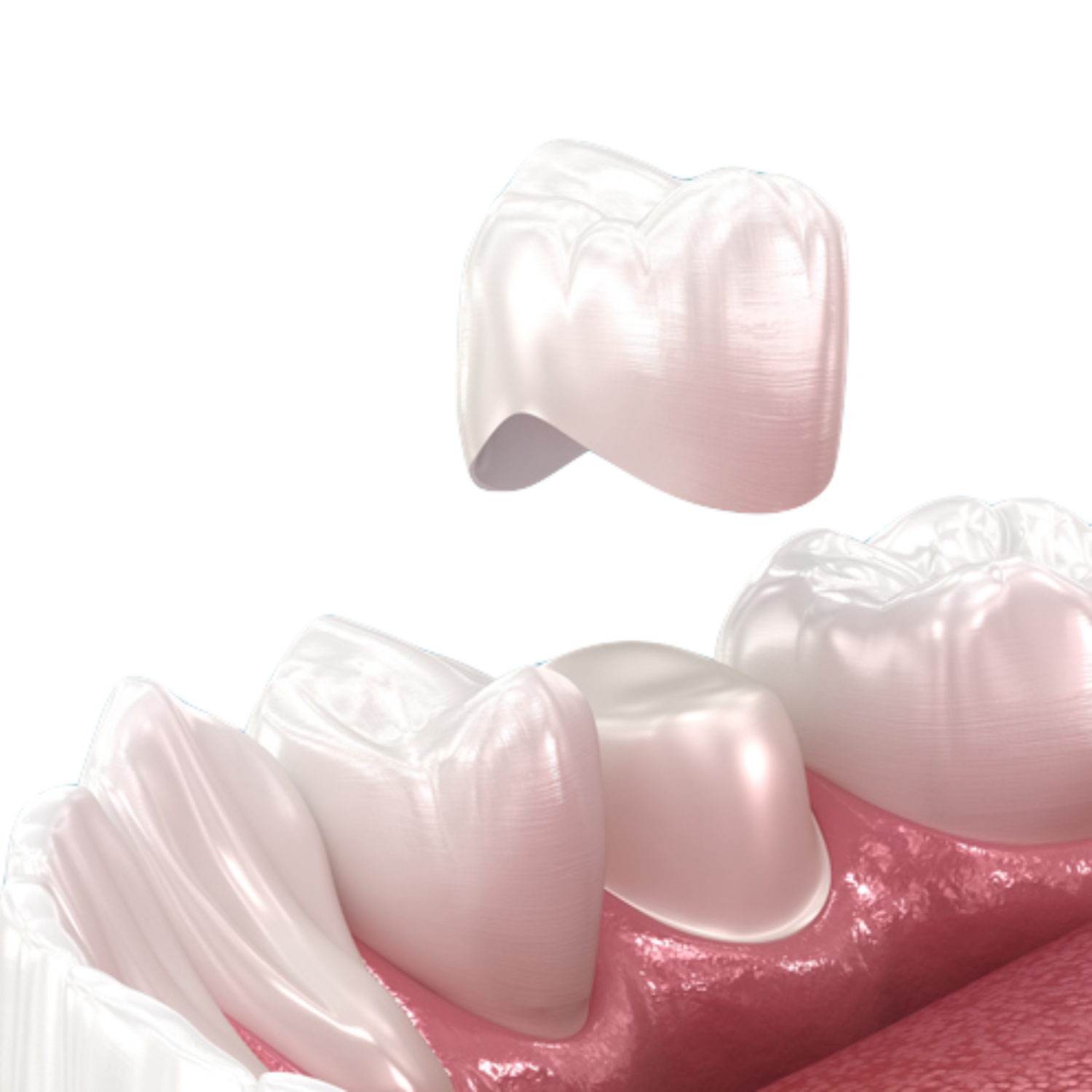 Temporary Crown Placement