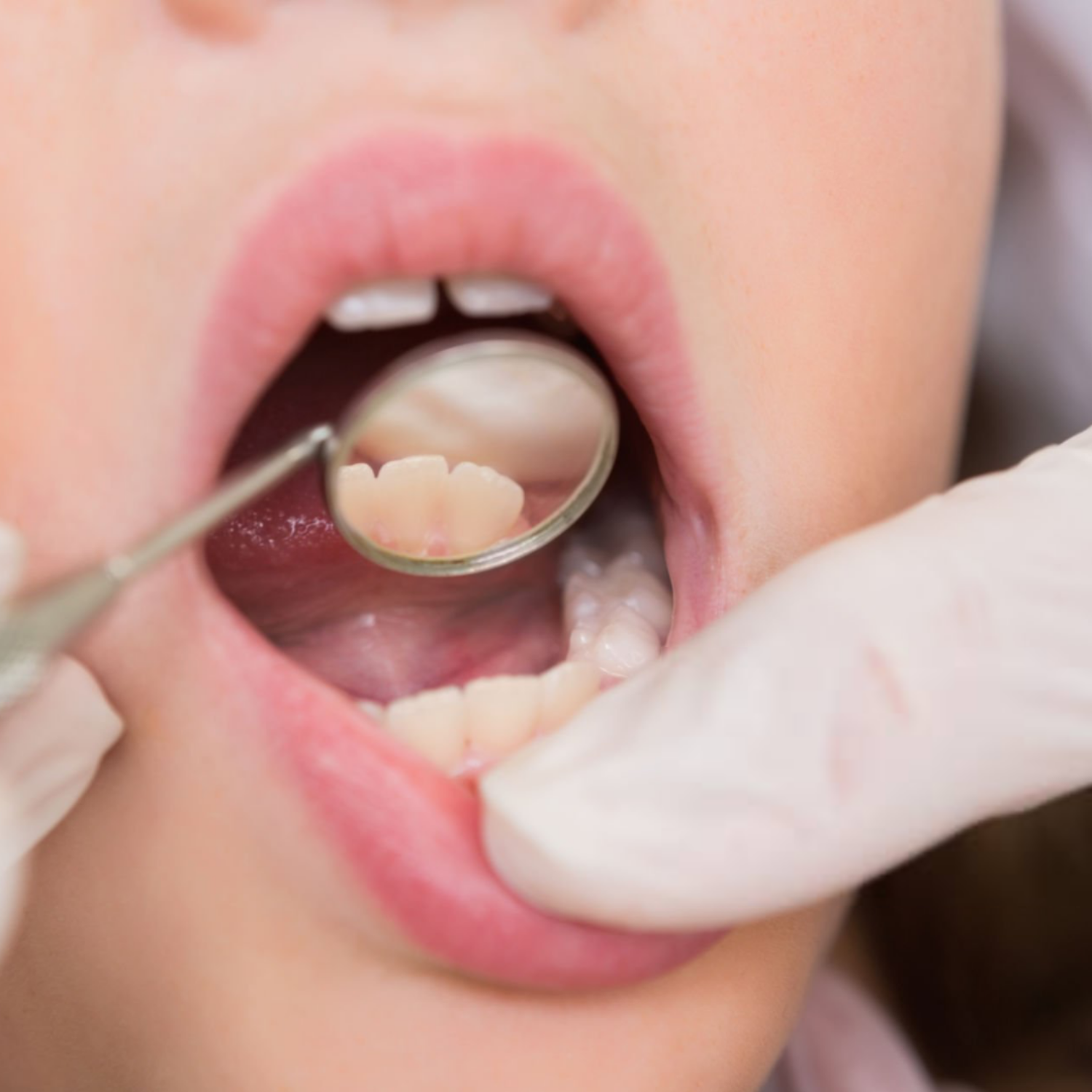 When Does a Child Need a Space Maintainer?