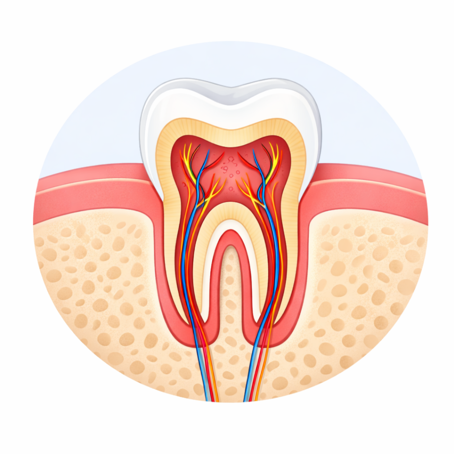 What is tooth decay?