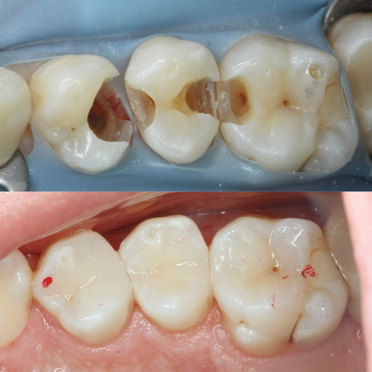 Occlusal Check