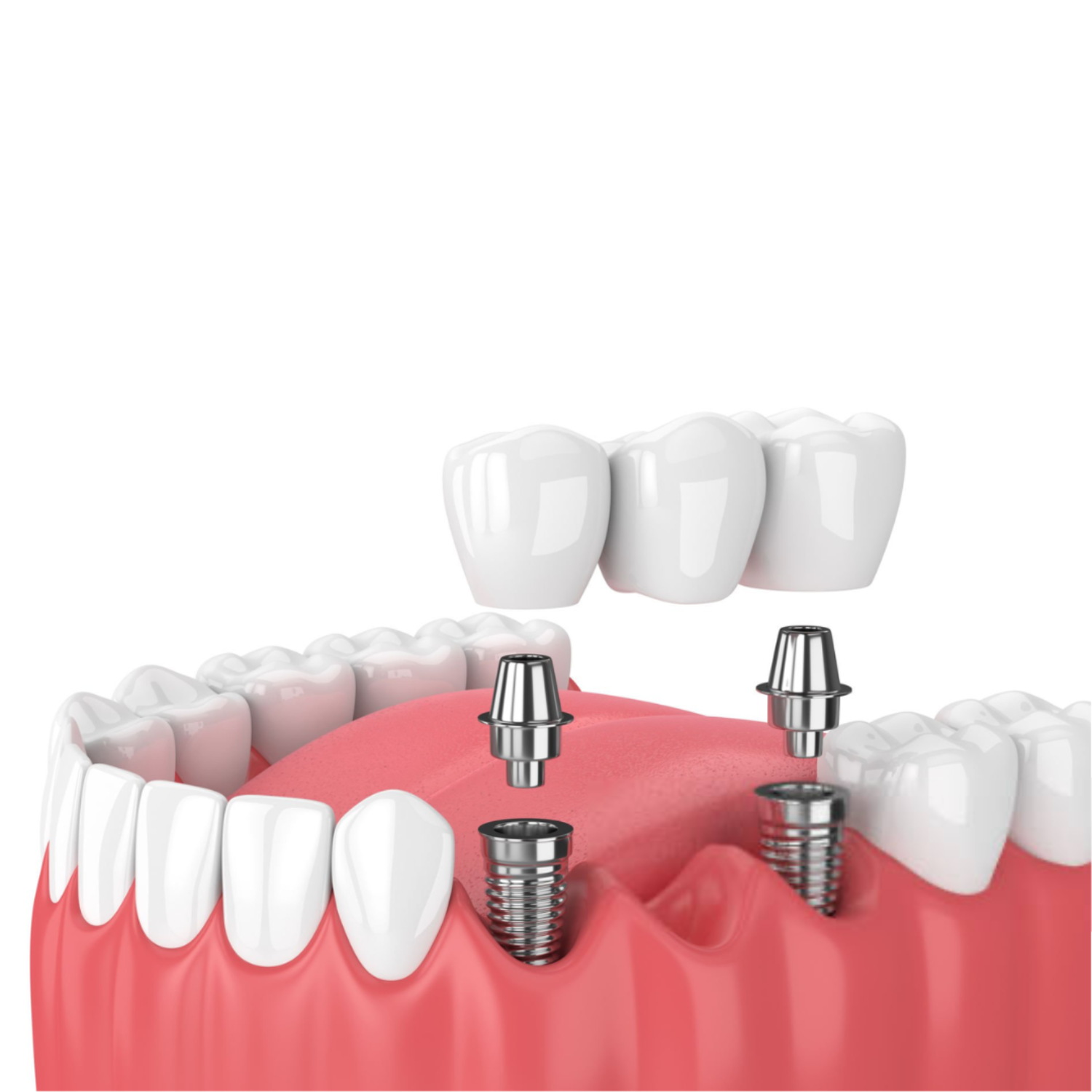2. Fixed dentures and bridges